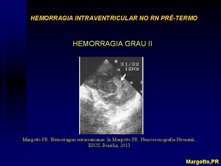HEMORRAGIA INTRAVENTRICULAR NO RN PRÉ-TERMO HEMORRAGIA GRAU II Margotto PR. Hemorragias intracranianas. In. Margotto