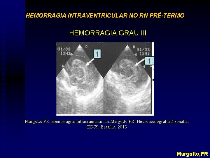 HEMORRAGIA INTRAVENTRICULAR NO RN PRÉ-TERMO HEMORRAGIA GRAU III Margotto PR. Hemorragias intracranianas. In. Margotto