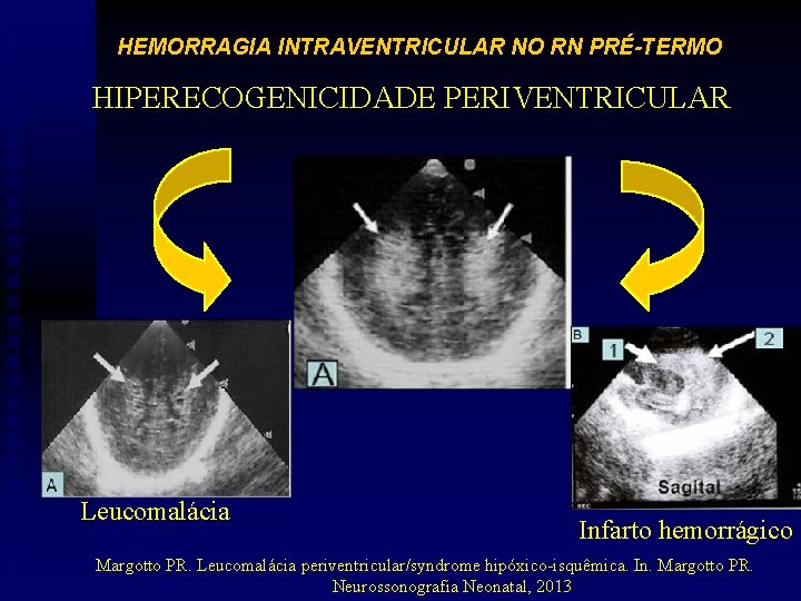 HEMORRAGIA INTRAVENTRICULAR NO RN PRÉ-TERMO HIPERECOGENICIDADE PERIVENTRICULAR Leucomalácia Infarto hemorrágico Margotto PR. Leucomalácia periventricular/syndrome