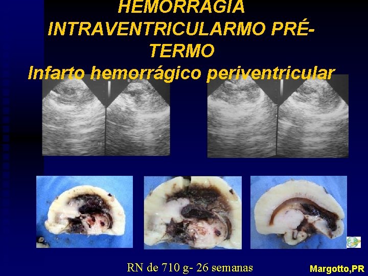 HEMORRAGIA INTRAVENTRICULARMO PRÉTERMO Infarto hemorrágico periventricular RN de 710 g- 26 semanas Margotto, PR