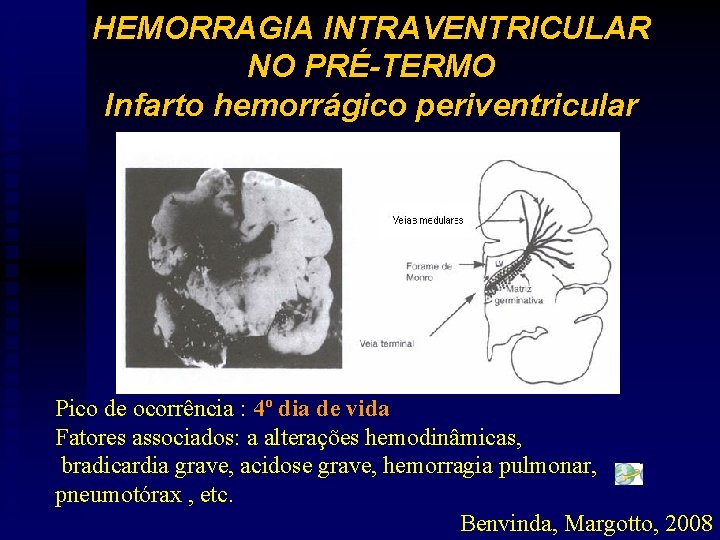 HEMORRAGIA INTRAVENTRICULAR NO PRÉ-TERMO Infarto hemorrágico periventricular Pico de ocorrência : 4º dia de