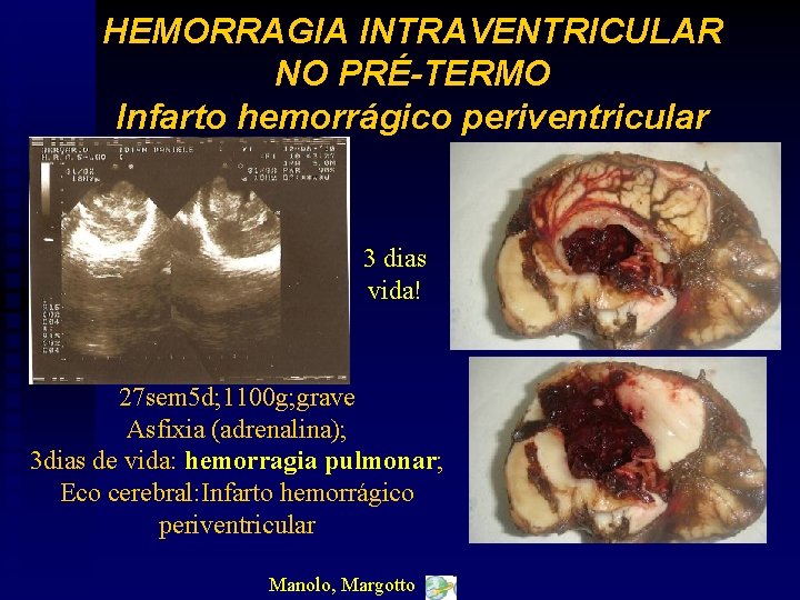 HEMORRAGIA INTRAVENTRICULAR NO PRÉ-TERMO Infarto hemorrágico periventricular 3 dias vida! 27 sem 5 d;