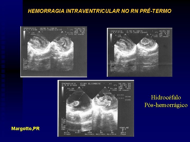 HEMORRAGIA INTRAVENTRICULAR NO RN PRÉ-TERMO Hidrocéfalo Pós-hemorrágico Margotto, PR 
