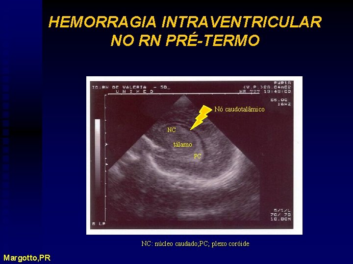 HEMORRAGIA INTRAVENTRICULAR NO RN PRÉ-TERMO Nó caudotalâmico NC tálamo PC NC: núcleo caudado; PC;