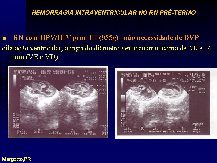 HEMORRAGIA INTRAVENTRICULAR NO RN PRÉ-TERMO SIGNIFICADO PERINATAL DAS DILATAÇÕES VENTRICULARES CEREBRAIS RN com HPV/HIV
