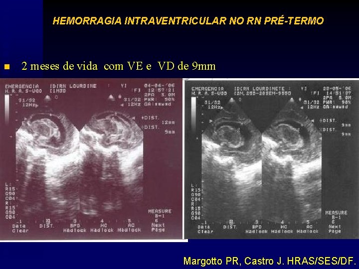 HEMORRAGIA INTRAVENTRICULAR NO RN PRÉ-TERMO n 2 meses de vida com VE e VD
