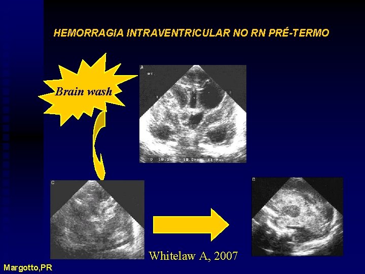 HEMORRAGIA INTRAVENTRICULAR NO RN PRÉ-TERMO Brain wash Whitelaw A, 2007 Margotto, PR 