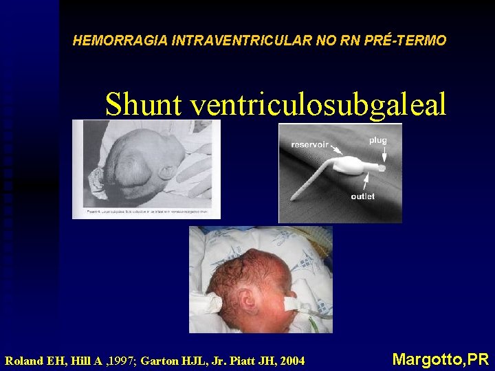 HEMORRAGIA INTRAVENTRICULAR NO RN PRÉ-TERMO Shunt ventriculosubgaleal Roland EH, Hill A , 1997; Garton