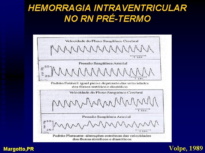 HEMORRAGIA INTRAVENTRICULAR NO RN PRÉ-TERMO Margotto, PR Volpe, 1989 