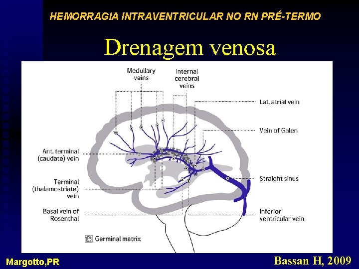HEMORRAGIA INTRAVENTRICULAR NO RN PRÉ-TERMO Drenagem venosa Margotto, PR Bassan H, 2009 