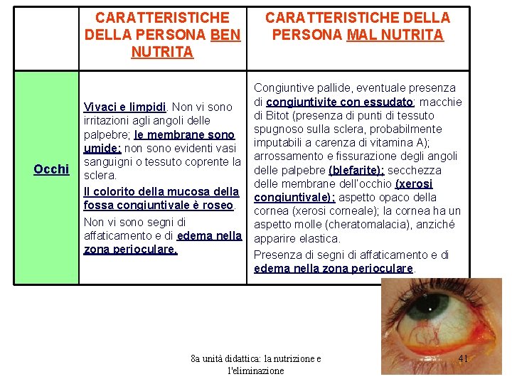 CARATTERISTICHE DELLA PERSONA BEN NUTRITA Occhi CARATTERISTICHE DELLA PERSONA MAL NUTRITA Congiuntive pallide, eventuale