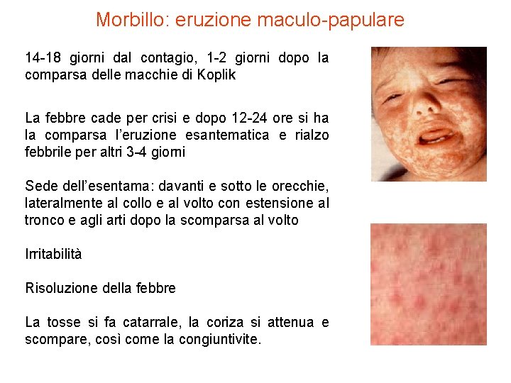 Morbillo: eruzione maculo-papulare 14 -18 giorni dal contagio, 1 -2 giorni dopo la comparsa