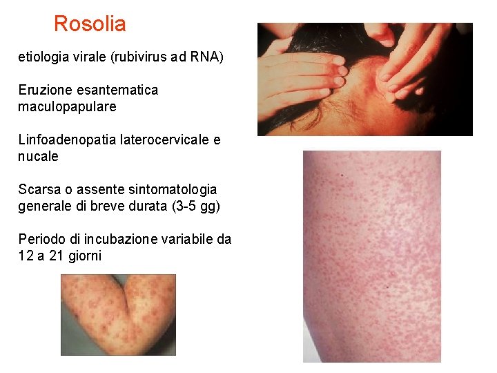 Rosolia etiologia virale (rubivirus ad RNA) Eruzione esantematica maculopapulare Linfoadenopatia laterocervicale e nucale Scarsa