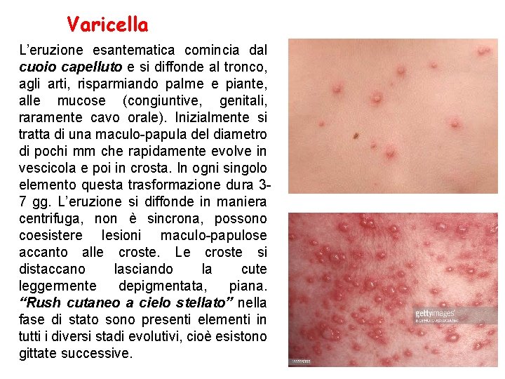 Varicella L’eruzione esantematica comincia dal cuoio capelluto e si diffonde al tronco, agli arti,