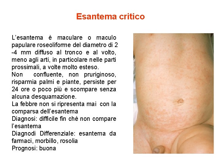 Esantema critico L’esantema è maculare o maculo papulare roseoliforme del diametro di 2 -4