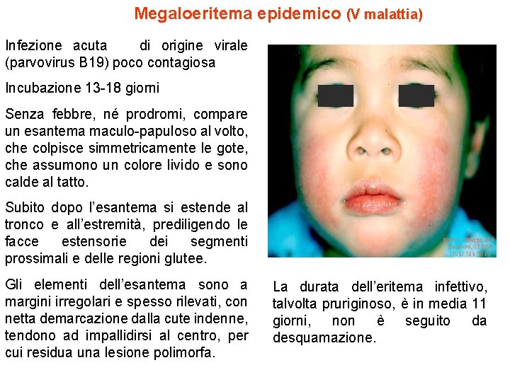 Megaloeritema epidemico (V malattia) Infezione acuta di origine virale (parvovirus B 19) poco contagiosa