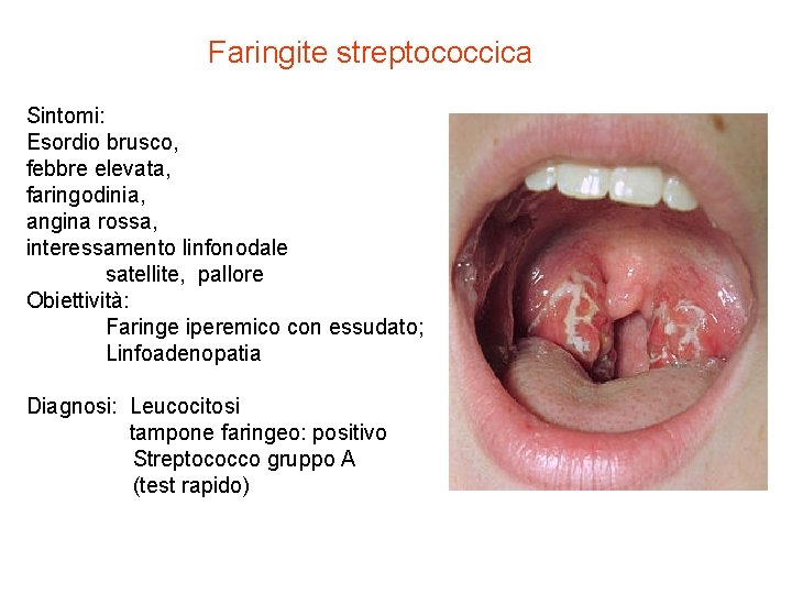 Faringite streptococcica Sintomi: Esordio brusco, febbre elevata, faringodinia, angina rossa, interessamento linfonodale satellite, pallore