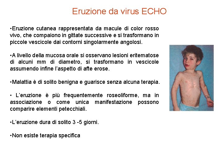 Eruzione da virus ECHO • Eruzione cutanea rappresentata da macule di color rosso vivo,