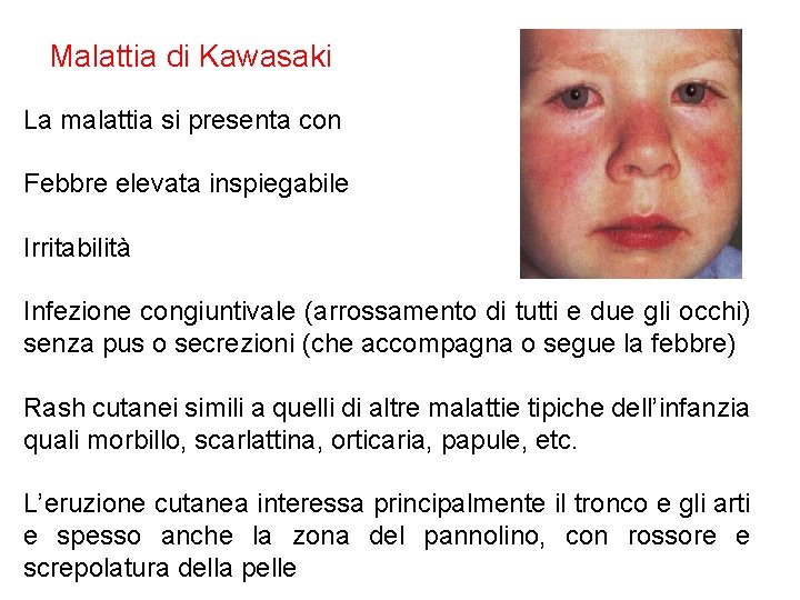 Malattia di Kawasaki La malattia si presenta con Febbre elevata inspiegabile Irritabilità Infezione congiuntivale