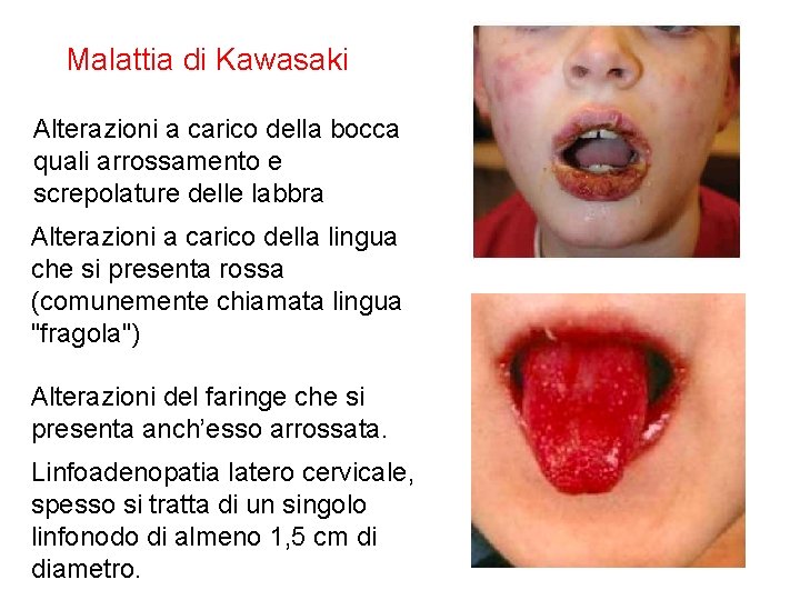 Malattia di Kawasaki Alterazioni a carico della bocca quali arrossamento e screpolature delle labbra