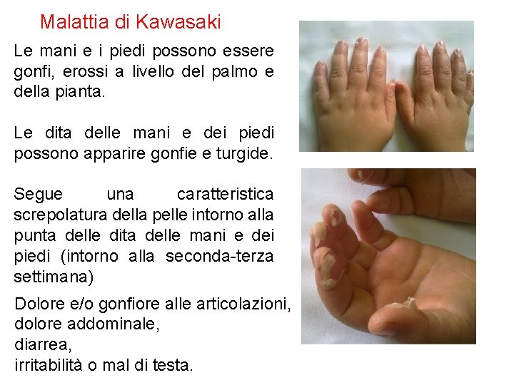 Malattia di Kawasaki Le mani e i piedi possono essere gonfi, erossi a livello