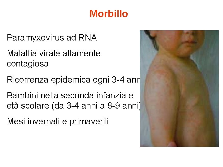 Morbillo Paramyxovirus ad RNA Malattia virale altamente contagiosa Ricorrenza epidemica ogni 3 -4 anni