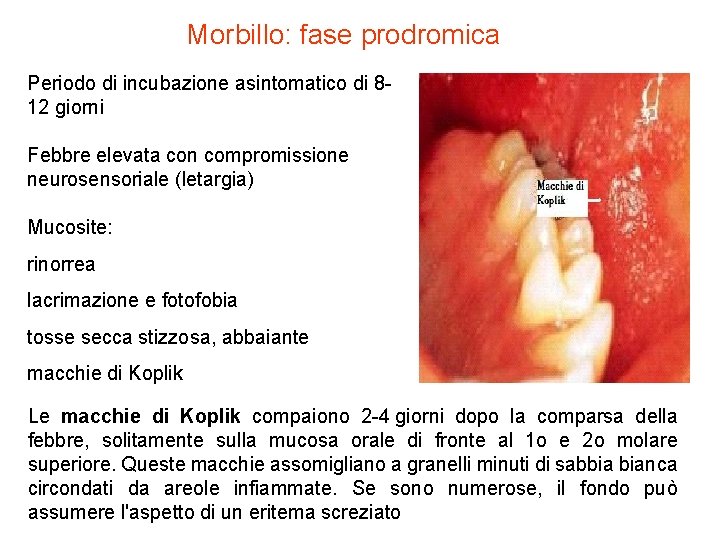 Morbillo: fase prodromica Periodo di incubazione asintomatico di 812 giorni Febbre elevata con compromissione