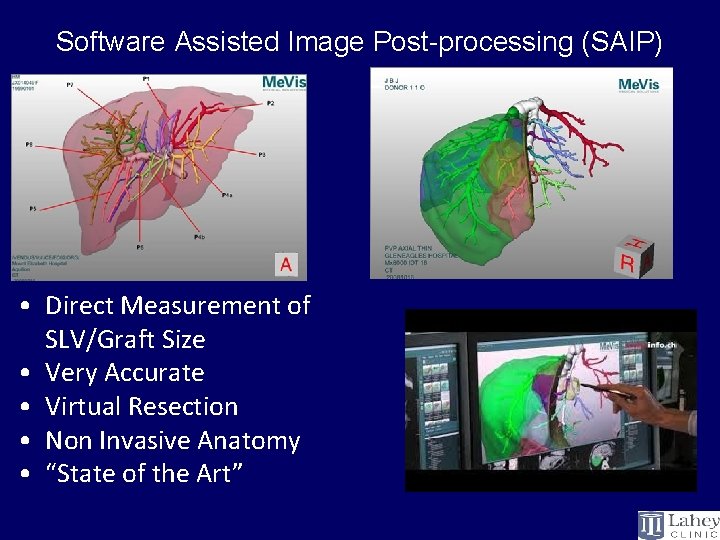 Software Assisted Image Post-processing (SAIP) • Direct Measurement of SLV/Graft Size • Very Accurate