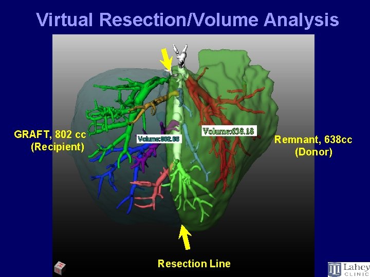 Virtual Resection/Volume Analysis GRAFT, 802 cc (Recipient) Remnant, 638 cc (Donor) Resection Line 