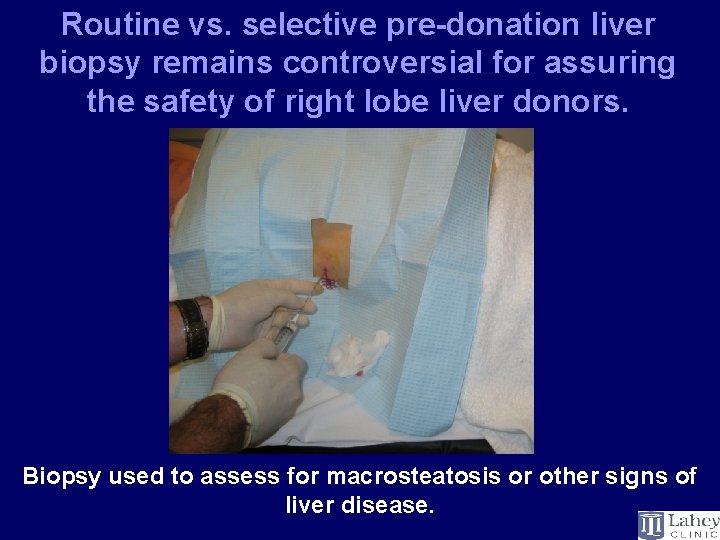 Routine vs. selective pre-donation liver biopsy remains controversial for assuring the safety of right