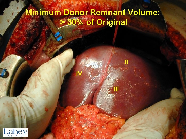 Minimum Donor Remnant Volume: > 30% of Original II IV III 