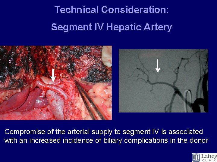 Technical Consideration: Segment IV Hepatic Artery Compromise of the arterial supply to segment IV