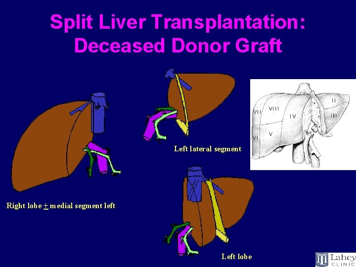 Split Liver Transplantation: Deceased Donor Graft Left lateral segment Right lobe + medial segment