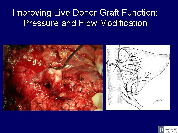 Improving Live Donor Graft Function: Pressure and Flow Modification 