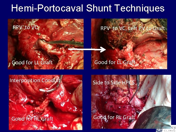 Hemi-Portocaval Shunt Techniques RPV to VC Good for LL Graft Interposition Conduit Good for