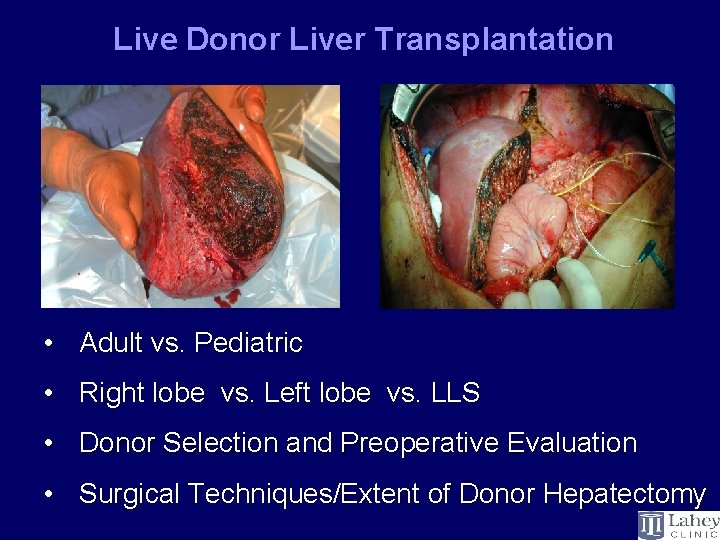 Live Donor Liver Transplantation • Adult vs. Pediatric • Right lobe vs. Left lobe