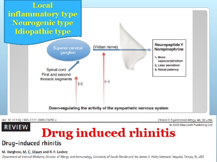 Local inflammatory type Neurogenic type Idiopathic type Drug induced rhinitis 