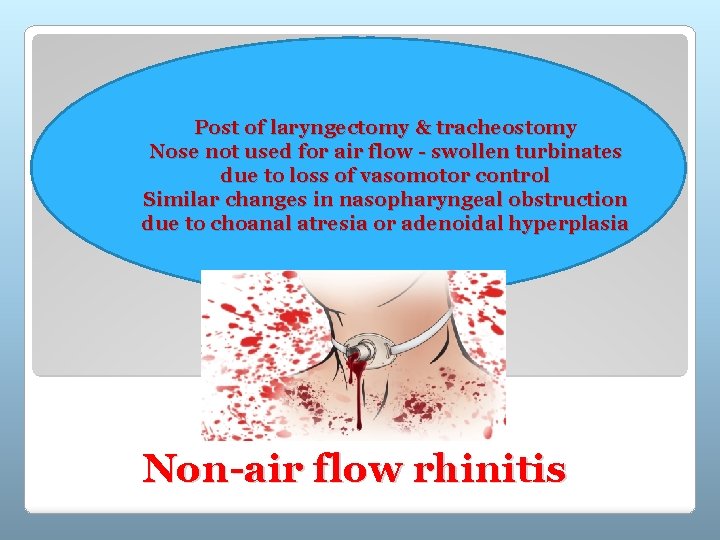 Post of laryngectomy & tracheostomy Nose not used for air flow - swollen turbinates