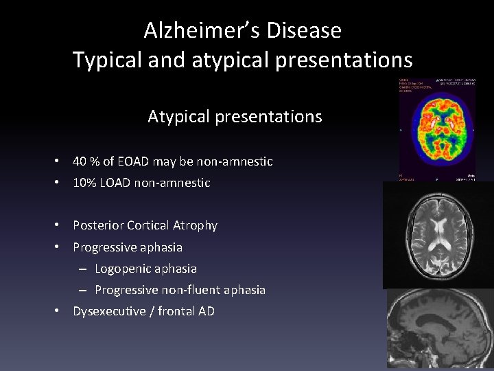 Alzheimer’s Disease Typical and atypical presentations Atypical presentations • 40 % of EOAD may
