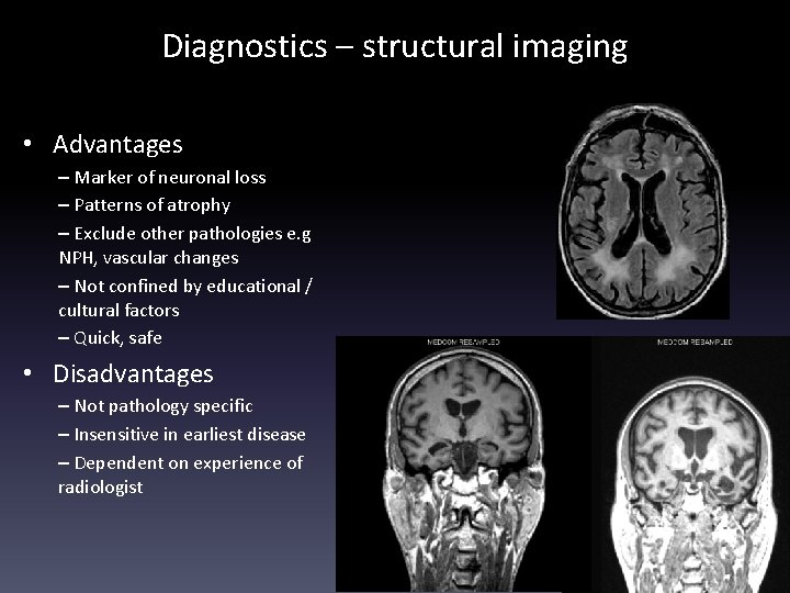 Diagnostics – structural imaging • Advantages – Marker of neuronal loss – Patterns of