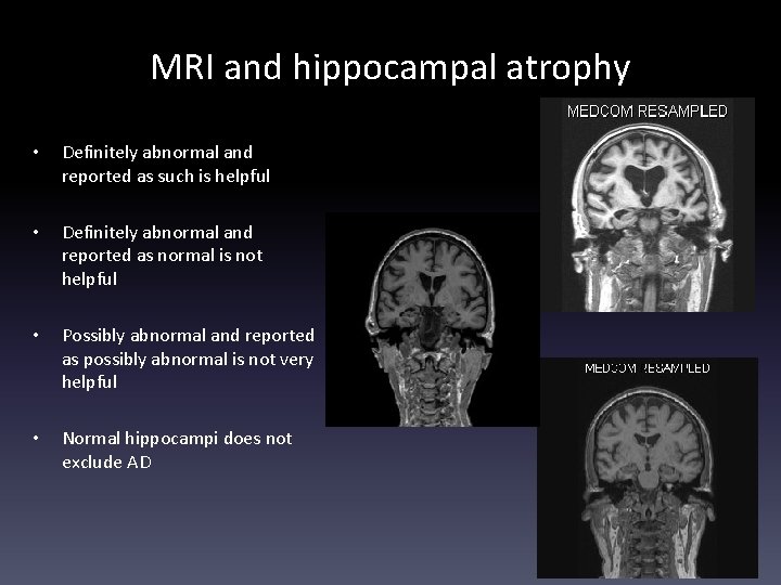 MRI and hippocampal atrophy • Definitely abnormal and reported as such is helpful •
