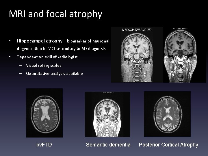 MRI and focal atrophy • Hippocampal atrophy – biomarker of neuronal degeneration in MCI