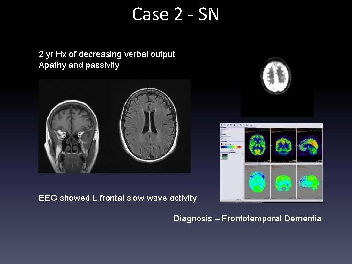Case 2 - SN 2 yr Hx of decreasing verbal output Apathy and passivity