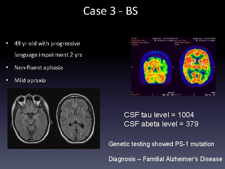 Case 3 - BS • 49 yr old with progressive language impairment 2 yrs