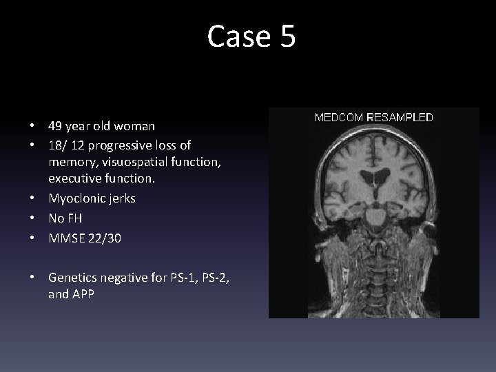 Case 5 • 49 year old woman • 18/ 12 progressive loss of memory,