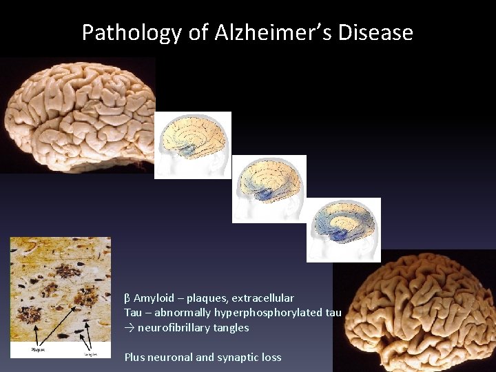 Pathology of Alzheimer’s Disease β Amyloid – plaques, extracellular Tau – abnormally hyperphosphorylated tau