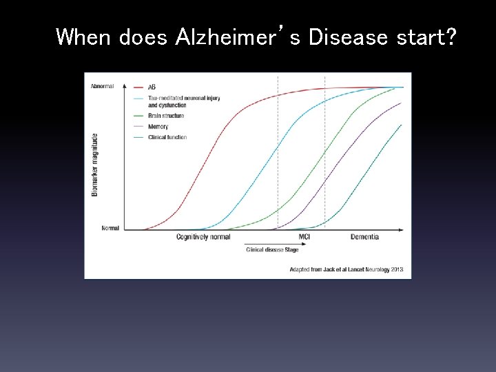 When does Alzheimer’s Disease start? 