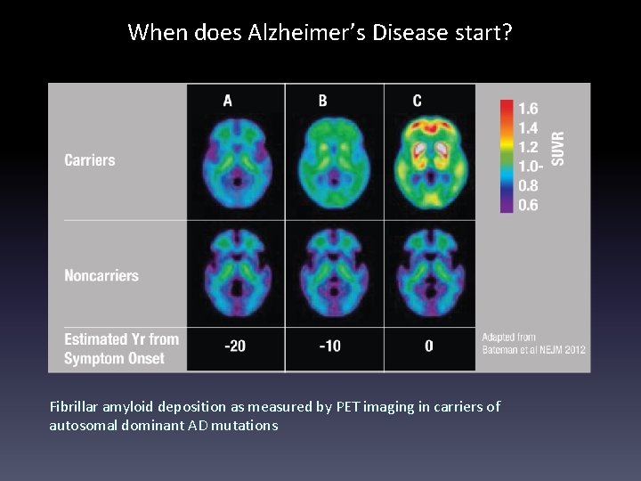 When does Alzheimer’s Disease start? Fibrillar amyloid deposition as measured by PET imaging in