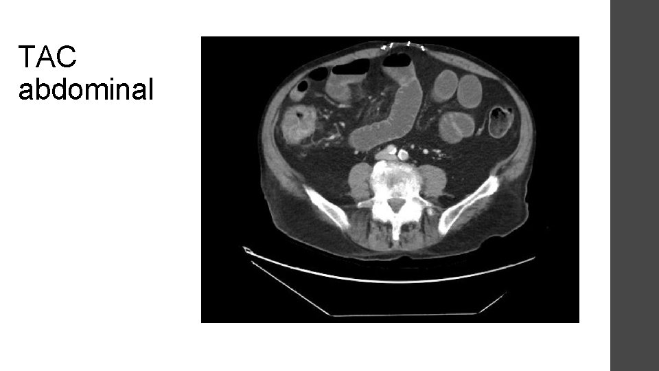 TAC abdominal 