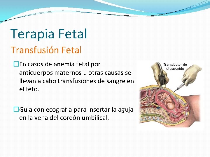 Terapia Fetal Transfusión Fetal �En casos de anemia fetal por anticuerpos maternos u otras